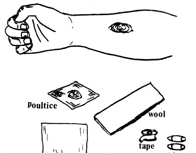 Equipment for Poultice