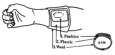 Applying the Poultice